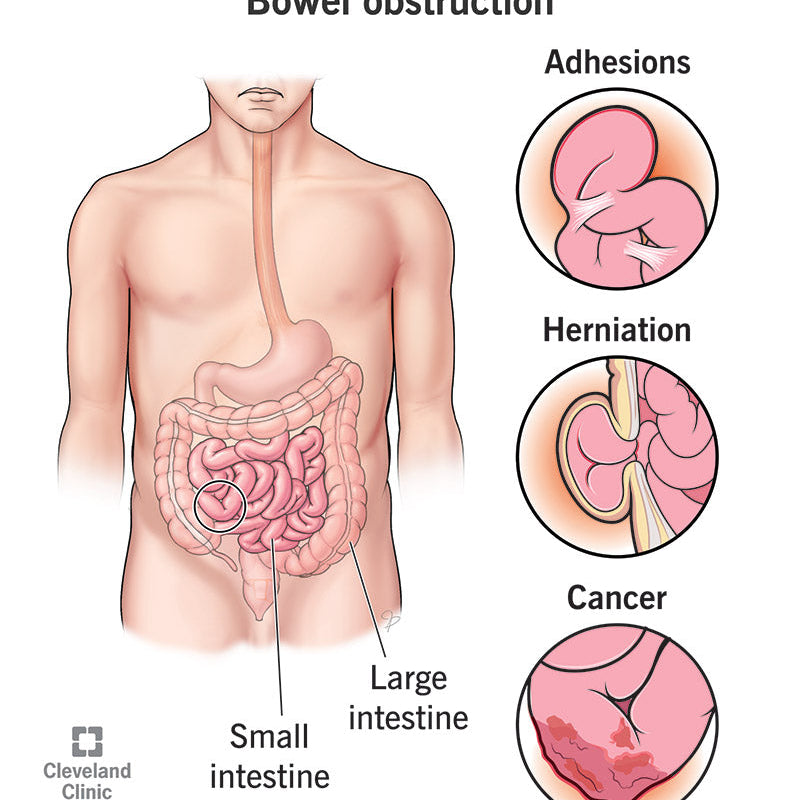 Fibre to Prevent Bowel Issues