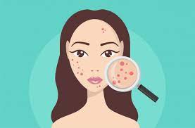 Can Gut Health Cause Pimples? - IV Nutrition