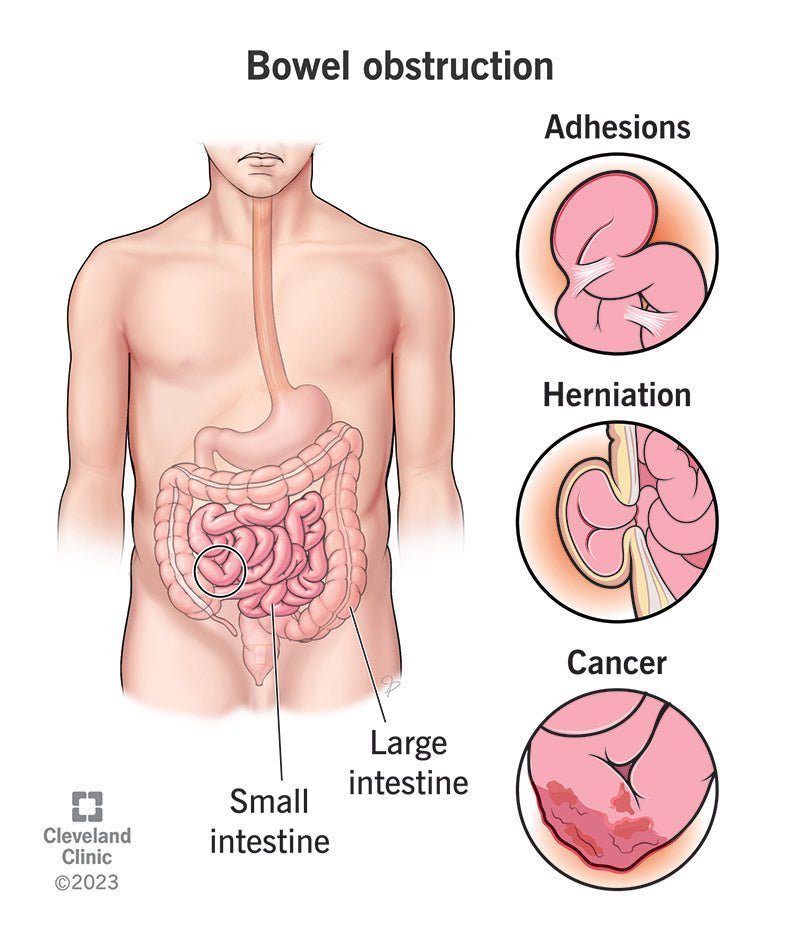 Fibre to Prevent Bowel Issues - IV Nutrition