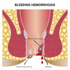Hemorrhoids and Gut Health - IV Nutrition