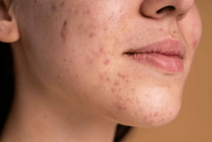 How Can I Improve My Gut Health for Acne? - IV Nutrition