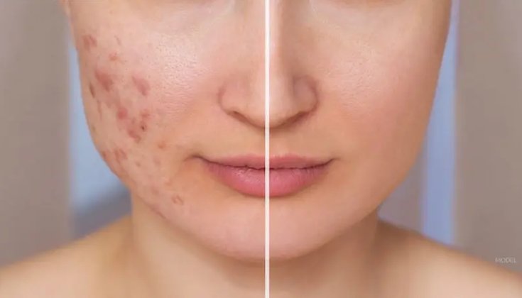 How Can I Improve My Gut Health for Acne? - IV Nutrition