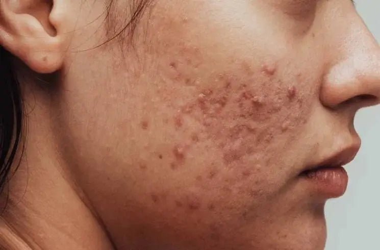 How to prevent acne outbreaks - IV Nutrition