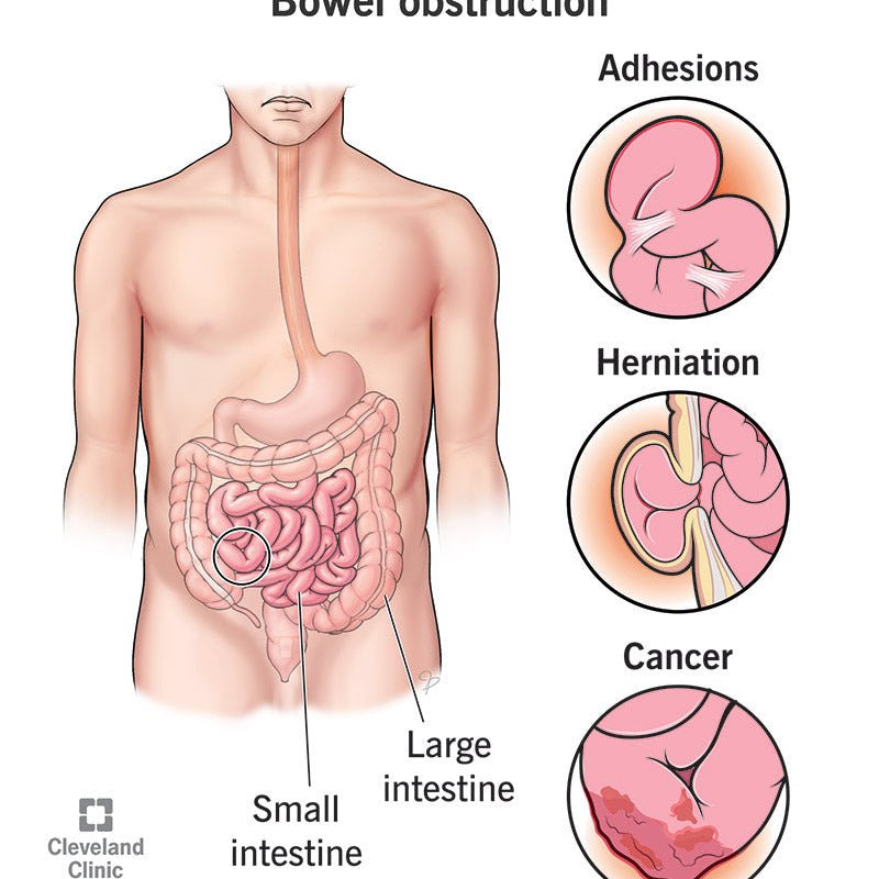 The Importance of Fibre for Our Bowels - IV Nutrition