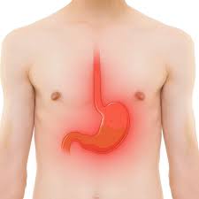 What Is the Best Thing for Heartburn? A Science-Backed, Clinical (and a Little Fun) Guide to Finding Real Relief - IV Nutrition